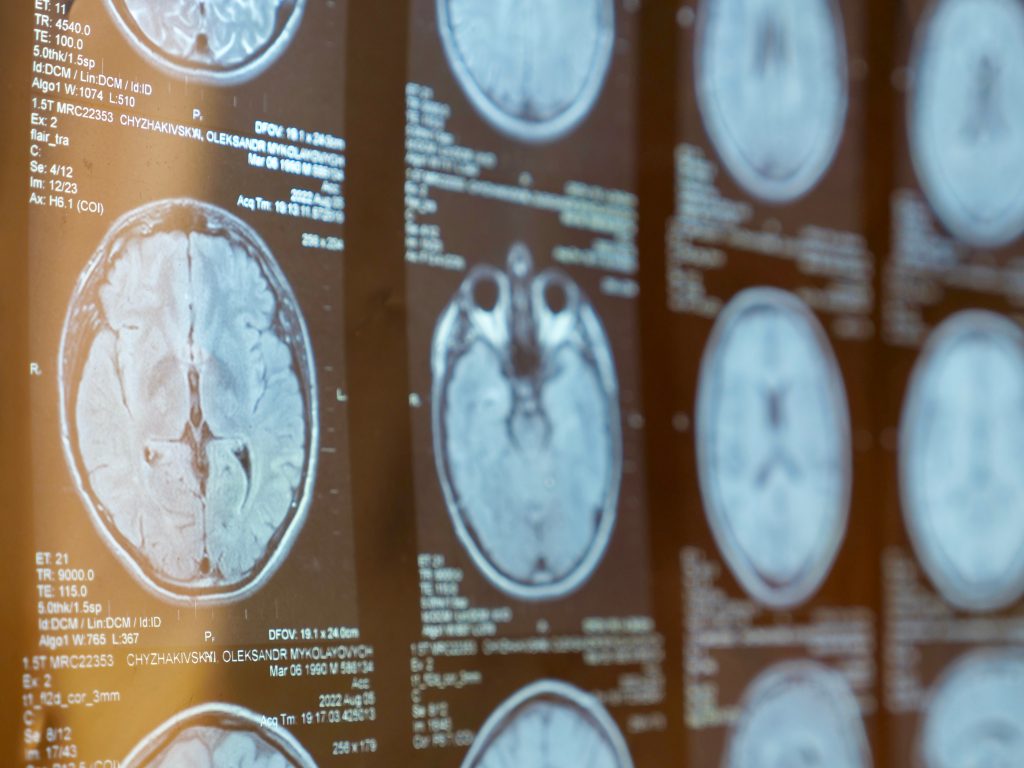 Esclerosis múltiple: una de las principales       causas de discapacidad neurológica                     entre los 20 y 40 años